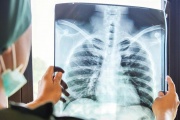 Sólo el 20% de los pacientes con cáncer de pulmón fue diagnóstico a tiempo