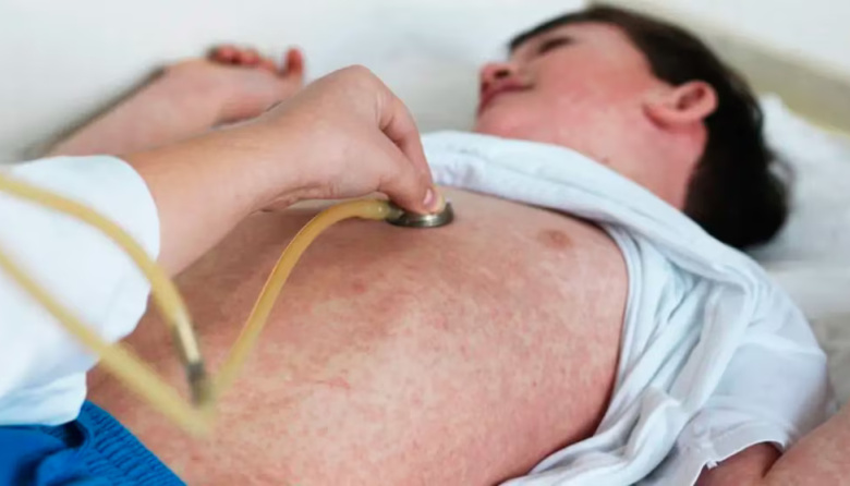 Un caso confirmado de sarampión en un niño de 2 años en Entre Ríos encendió las alarmas sanitarias en Argentina