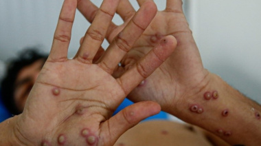 Preocupación: Registraron en Argentina el primer caso de la cepa más agresiva y contagiosa de la "viruela del mono"